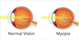 Refractive