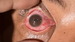 Uveitis